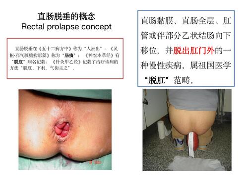 六、九、硬化剂在治疗直肠脱垂中的作用